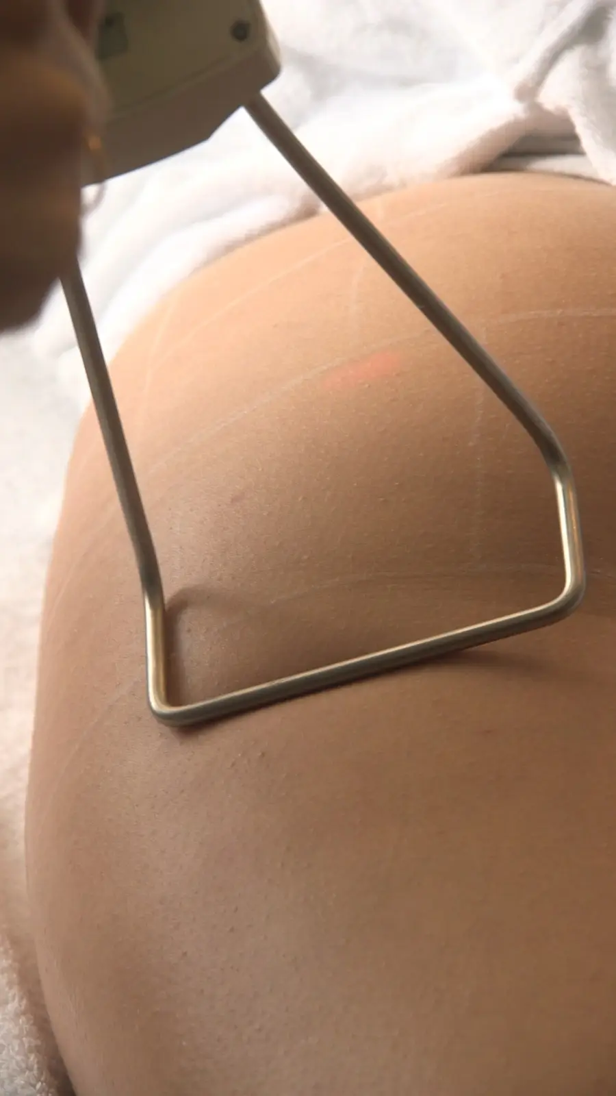 Laser Fotona® TightSculpting
